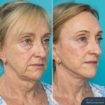 12 Months Post-op Face Lift and Posterior Neck Lift