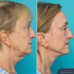 12 Months Post-op Face Lift and Posterior Neck Lift