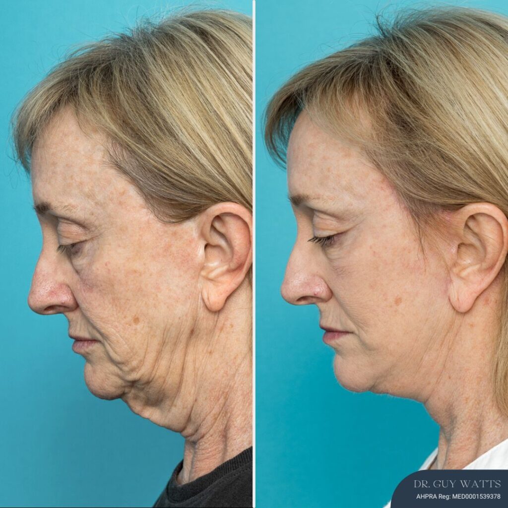 Post-op Face and Neck Lift