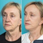 Post-op Face and Neck Lift