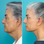 3mths Post Face Lift and Neck Lift