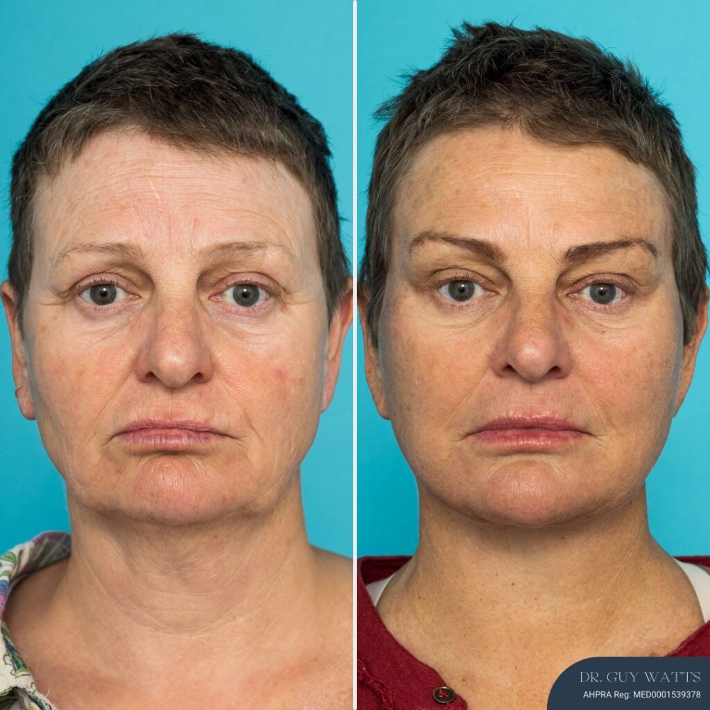 9 months post-op⁠ - Face & Neck Lift + Brow Lift