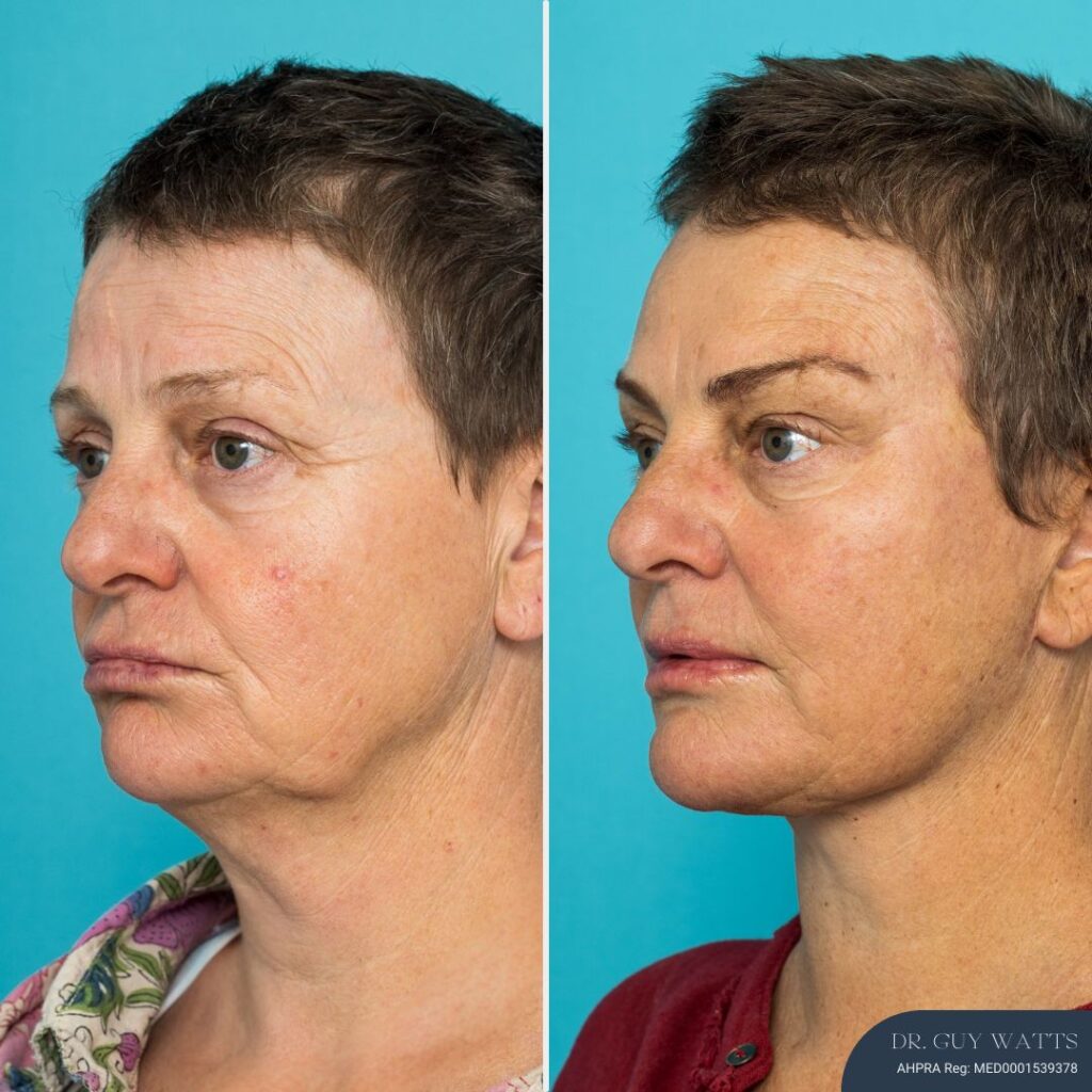 9 months post-op⁠ - Face & Neck Lift + Brow Lift