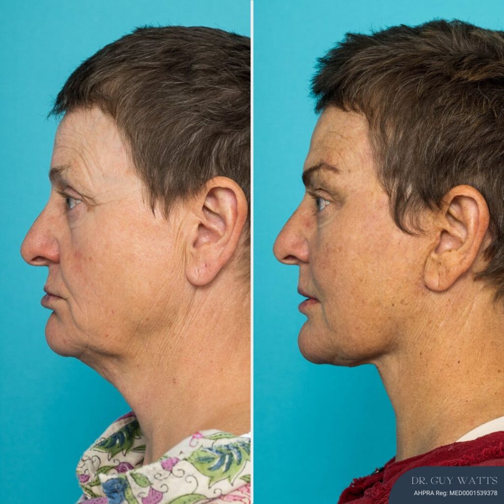 9 months post-op⁠ - Face & Neck Lift + Brow Lift