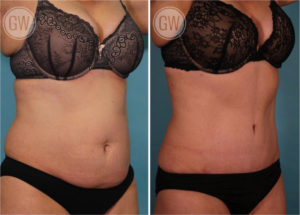Tummy tuck + 360 liposuction