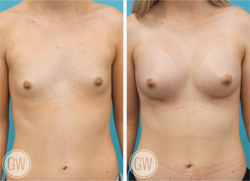 Breast Augmentation 260cc dual plane anatomical implants