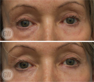 Lower eyelid surgery