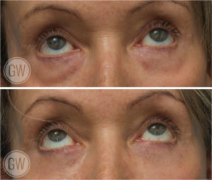 Lower eyelid surgery