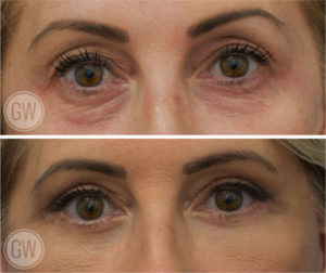 Upper and lower eyelid surgery