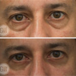 Scarless lower eyelid surgery