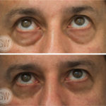 Scarless lower eyelid surgery
