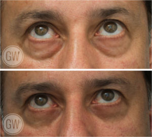 Scarless lower eyelid surgery