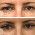 Upper and Lower Eyelid Surgery