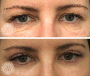 Upper and Lower Eyelid Surgery