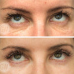 Upper and Lower Eyelid Surgery