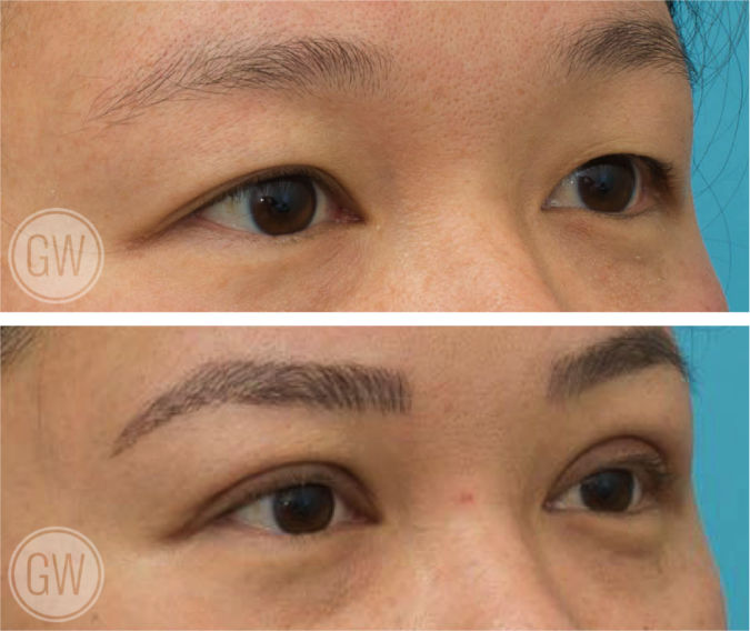 Asian eyelid surgery - Double eyelid
