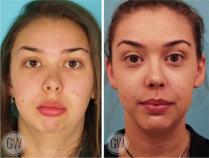 Genioplasty (horizontal & vertical lengthening) + Jaw Surgery