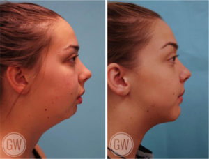 Genioplasty (horizontal & vertical lengthening) + Jaw Surgery