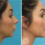 Genioplasty (vertical & horizontal lengthening) + Neck Liposuction