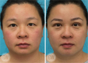 Genioplasty (vertical lengthening) + Double eyelid Surgery