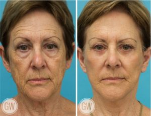 Facelift + Necklift + Lower eyelids + Temporal lift + 35% TCA peel