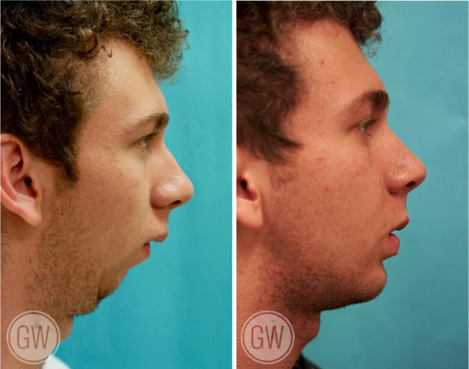 Chin augmentation - jaw surgery