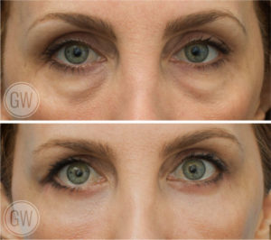 Lower eyelid surgery