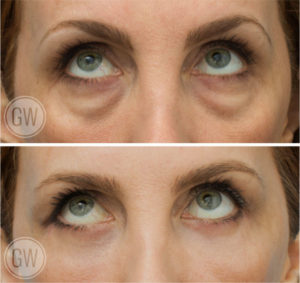 Lower eyelid surgery