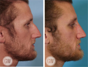 Rhinoplasty + Septoplasty