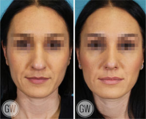 Rhinoplasty + Septoplasty