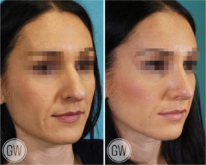 Rhinoplasty + Septoplasty