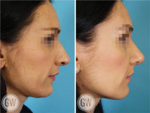 Rhinoplasty + Septoplasty