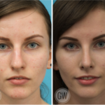 Rhinoplasty + septoplasty + turbinate reduction