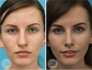 Rhinoplasty + septoplasty + turbinate reduction