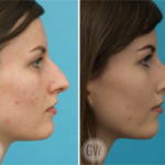 Rhinoplasty + septoplasty + turbinate reduction