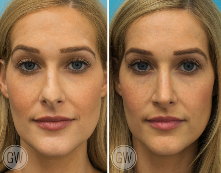 Rhinoplasty Septoplasty Turbinate Reduction Dr Guy Watts