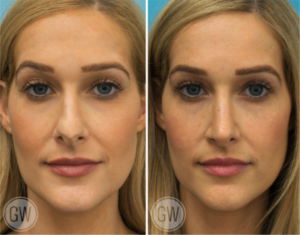 Rhinoplasty + septoplasty + turbinate reduction