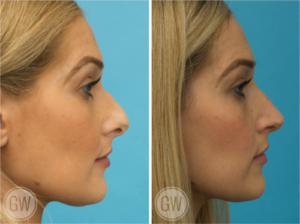 Rhinoplasty + septoplasty + turbinate reduction