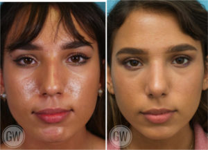 Rhinoplasty + septoplasty + turbinate reduction