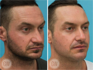 Rhinoplasty + vertical lengthening genioplasty