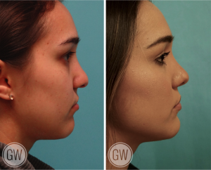 Rhinoplasty + Upper lip fat grafting