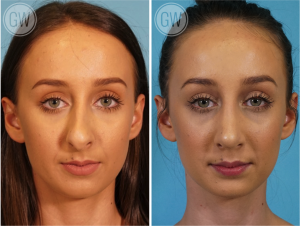 Rhinoplasty + Septoplasty