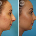 Nose surgery, Rhinoplasty, septoplasty