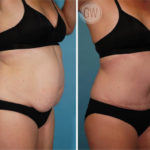 Tummy tuck + Liposuction abdomen and flanks