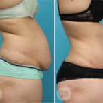Tummy Tuck + 360 Liposuction
