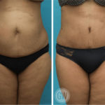 Tummy tuck + 360 liposuction including lateral thighs