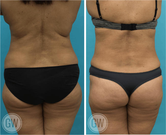 Tummy tuck + 360 liposuction including lateral thighs