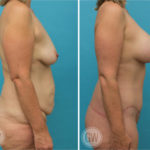 Total Body Lift - Lower Body Lift + Mons Pubis Lift + Thigh Lift + Arm Lift + Breast Implants & Lift