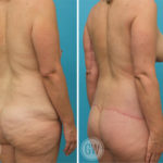 Total Body Lift - Lower Body Lift + Mons Pubis Lift + Thigh Lift + Arm Lift + Breast Implants & Lift