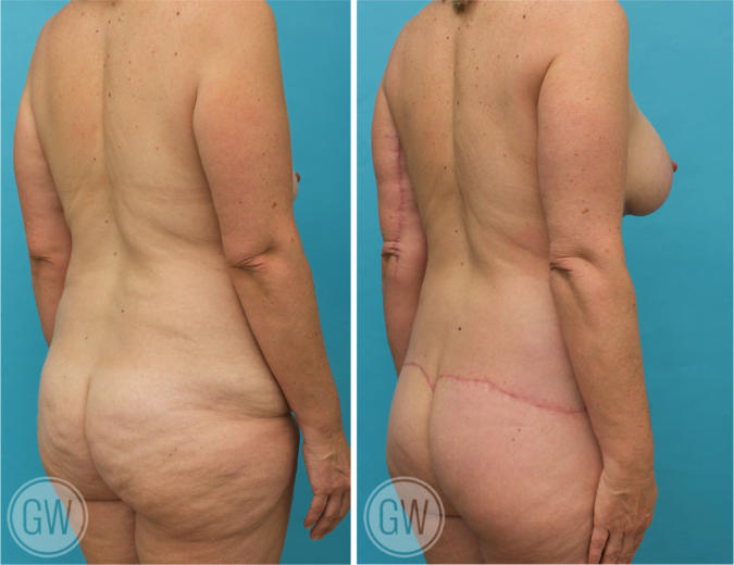 Mons Pubis Reduction: Can Liposuction or Tummy Tuck Help? (Updated Oct.  2023)